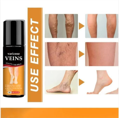 Fito™ Varicose & Spider Vein Spray | Natural Herbal Therapy for Swelling, Fatigue & Vein Health (Pack of 2)